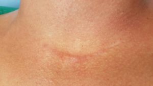 Contractubex az arcon lévő vörös foltokhoz - Mangán psoriasis kezelése
